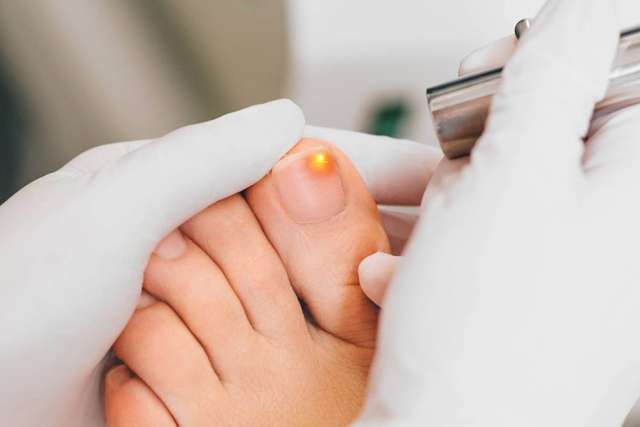 Fungal Nail Infection - Forum Health Centre